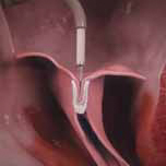 La Mitraclip